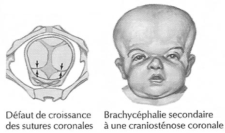 Brachycéphalie
